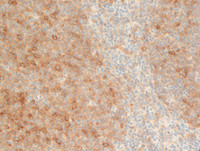 Follicular Lymphoma Grade 3a-HGAL