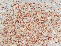 Follicular Lymphoma Grade 3a-Ki67