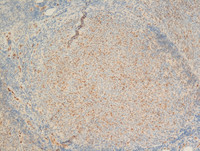 Follicular Lymphoma Grade 3a-LMO2