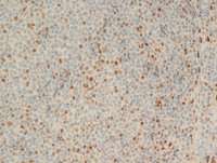 Follicular-Lymphoma-Grade-3aLMO2