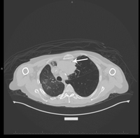 Plasmacytoma-Like PTLD, EBV+ CT Scan