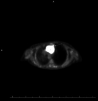 Plasmacytoma-Like PTLD, EBV+ Pet Scan