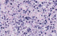 Plasmacytoma-Like PTLD, EBV+ EBER