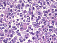 Plasmacytoma-Like PTLD, EBV+ H&E High Power