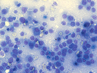 PlasmacytomaLike-PTLD-EBV-Pet-Scan