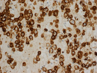 Primary-Effusion-LymphomaCD30