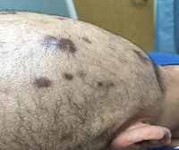 HIV-related Primary Effusion Lymphoma, HHV8+/EBV+