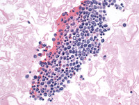 Primary Effusion Lymphoma-H&E Intermediate Power