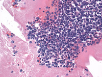 Primary Effusion Lymphoma-H&E High Power