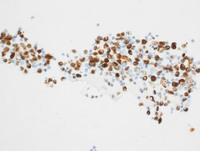 Primary-Effusion-LymphomaLANA