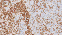 Extracavitary Primary Effusion Lymphoma-CD3