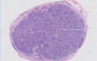 Extracavitary Primary Effusion Lymphoma-H&E Low Power