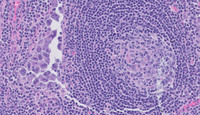 Extracavitary Primary Effusion Lymphoma-H&E High Power