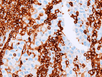 Extracavitary-Primary-Effusion-LymphomaCD45