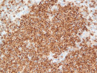 Nodal-Follicular-LymphomaBCL2