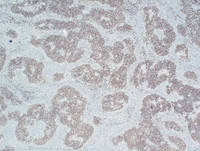 Nodal-Follicular-LymphomaBCL6