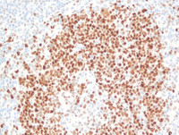 Nodal-Follicular-LymphomaBCL6
