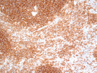 Nodal Follicular Lymphoma-CD10