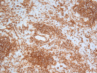Nodal-Follicular-LymphomaCD20