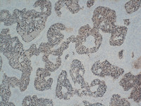 Nodal-Follicular-LymphomaCD21