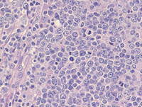 Nodal Follicular Lymphoma-H&E High Power