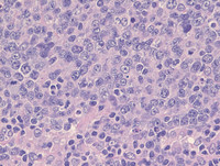 Nodal Follicular Lymphoma-H&E High Power