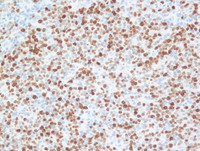 Nodal-Follicular-LymphomaKi67