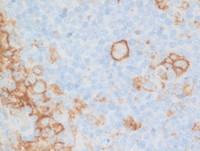 Nodal-Follicular-LymphomaPDL1