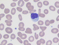 Chronic Lymphoproliferative Disorder of NK Cells - Flow Plots