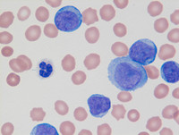 Mixed Phenotype Acute Leukemia, B/myeloid: Blood