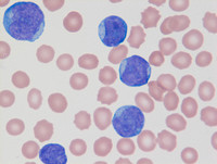 Mixed Phenotype Acute Leukemia, B/myeloid: Blood