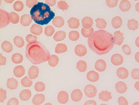 Mixed Phenotype Acute Leukemia, B/myeloid: Blood