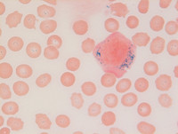 Mixed Phenotype Acute Leukemia, B/myeloid: Blood