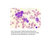 acute promyelocytic leukemia microgranular variant