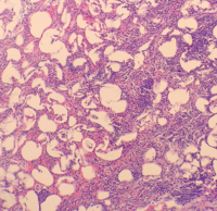 Adrenal Myelolipoma 2