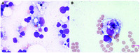 Lamotrigine-associated hemophagocytic lymphohistiocytosis