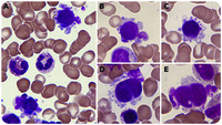 Nuclear protrusion in dysplastic micromegakaryocytes
