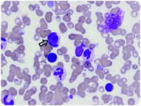 Unexpected bone marrow findings in a patient with pancytopenia and coagulopathy