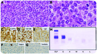 γ Heavy chain disease