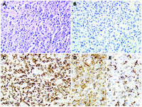 CAR T cells mimicking an aggressive lymphoma