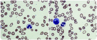 Acanthocytosis causing chronic hemolysis in a patient with advanced cirrhosis