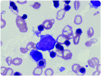 When nucleated RBCs “count” in the peripheral blood: a unique case of post–essential thrombocythemia myelofibrosis