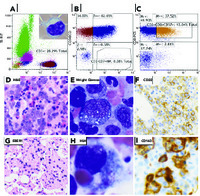 Immune dysregulation: EBV DLBCL and HLH in a patient with T-LGL