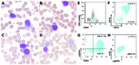 Azurophilic granular blasts are not always part of myeloid lineage: an atypical case of BCP acute lymphoblastic leukemia