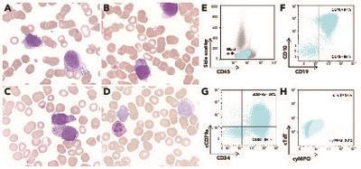 Azurophilic granular blasts are not always part of myeloid lineage: an atypical case of BCP acute lymphoblastic leukemia