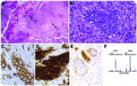 A young woman with intravascular large B-cell lymphoma in a benign-appearing endometrial polyp