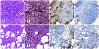 Neutrophilic leukemoid reaction with extended fibrosis due to ectopic G-CSF production