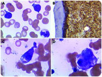 Mast cell leukemia and hemophagocytosis in a patient with myelodysplastic syndrome