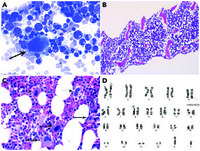 Unusual case of a myelodysplastic syndrome with novel inv(5)(q15q33)