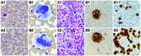 Striking emperipolesis in megakaryocytes of gray platelet syndrome